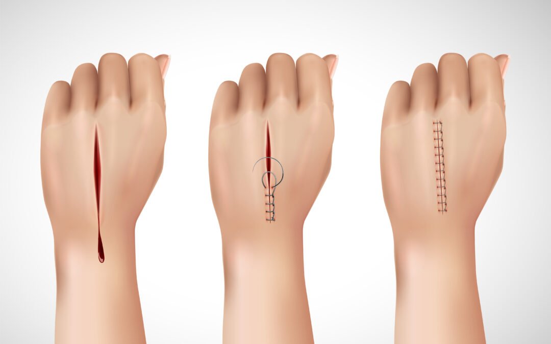 Cómo tratar una cortada profunda en casa antes de ir al medico